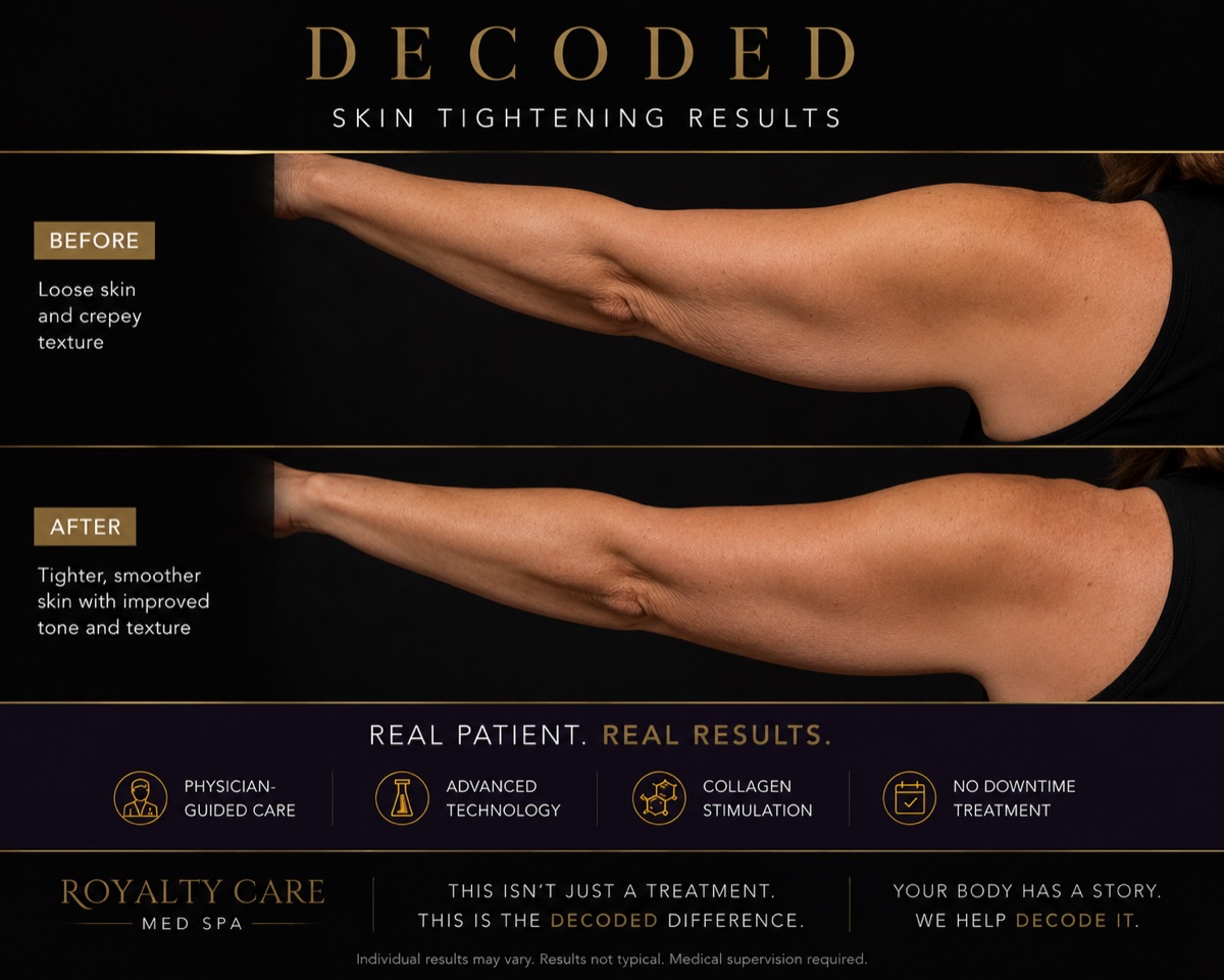 Royalty Care skin tightening before and after: improved skin tone and texture on a real patient